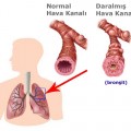 Bronşit nedir